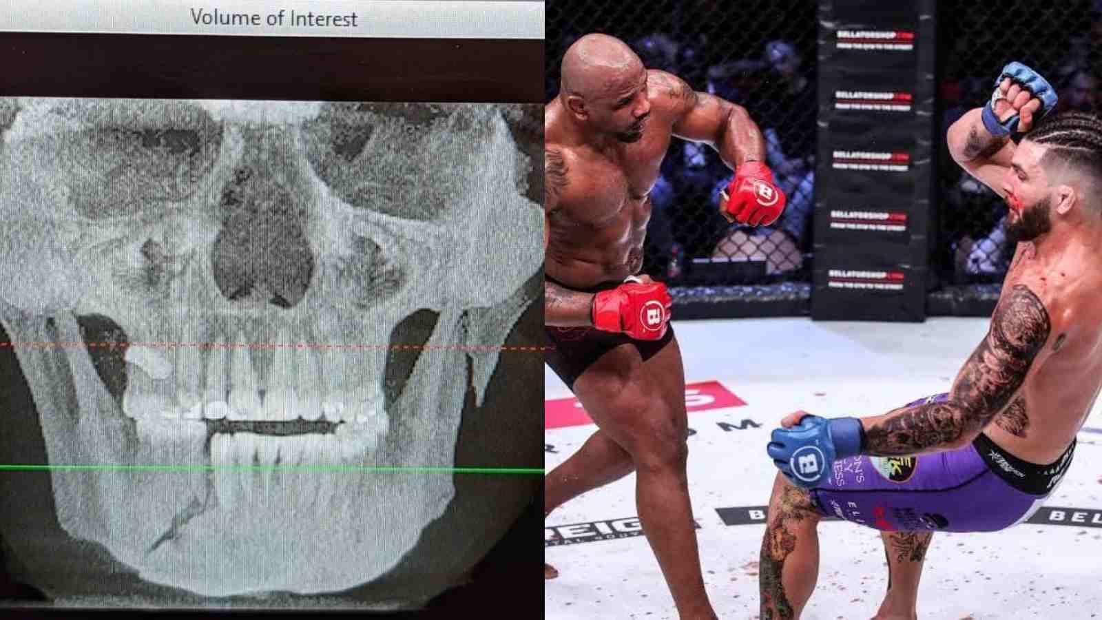 Shocking: Alex Polizzi shares an X-ray of the broken jaw following a violent TKO against Yoel Romero