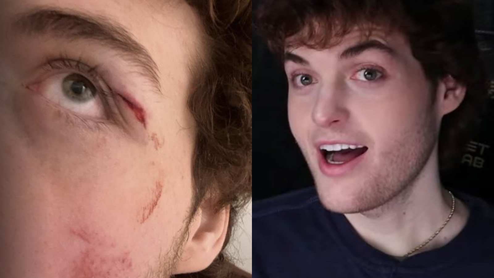 Why is Dream wearing an eyepatch at TwitchCon? Minecraft star talks about a painful injury during GeorgeNotFound’s stream